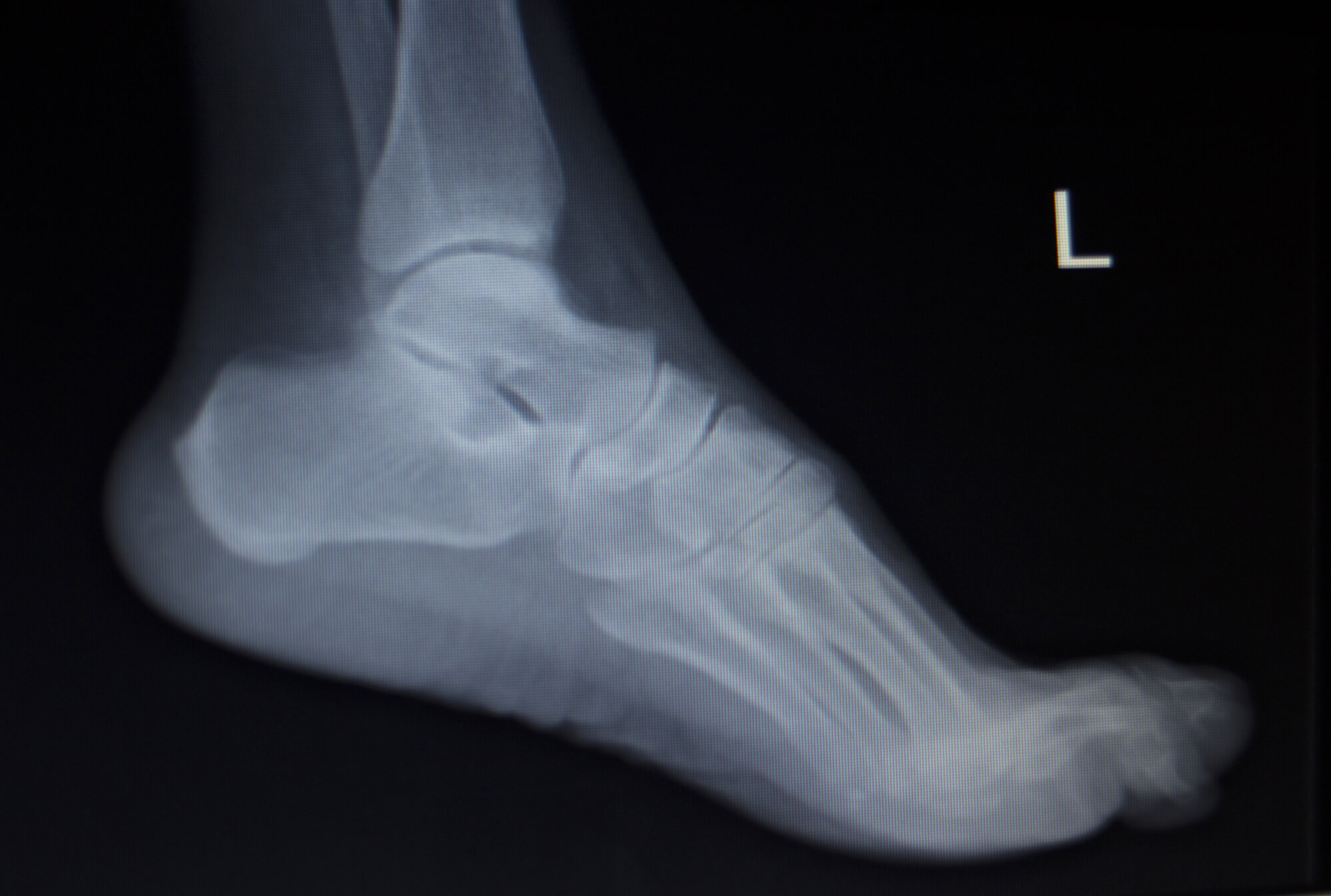 Assessing Heel Pain | Diagnostic Ultrasound of the Foot and Ankle