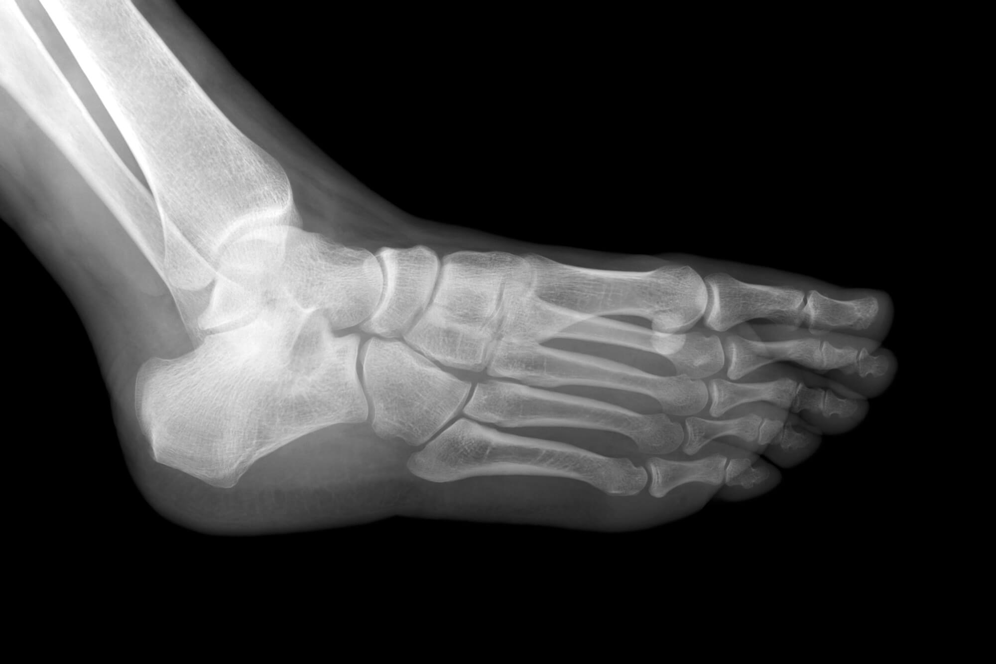 OrthoDx: Heel Pain in 12-Year-Old Boy - Clinical Advisor