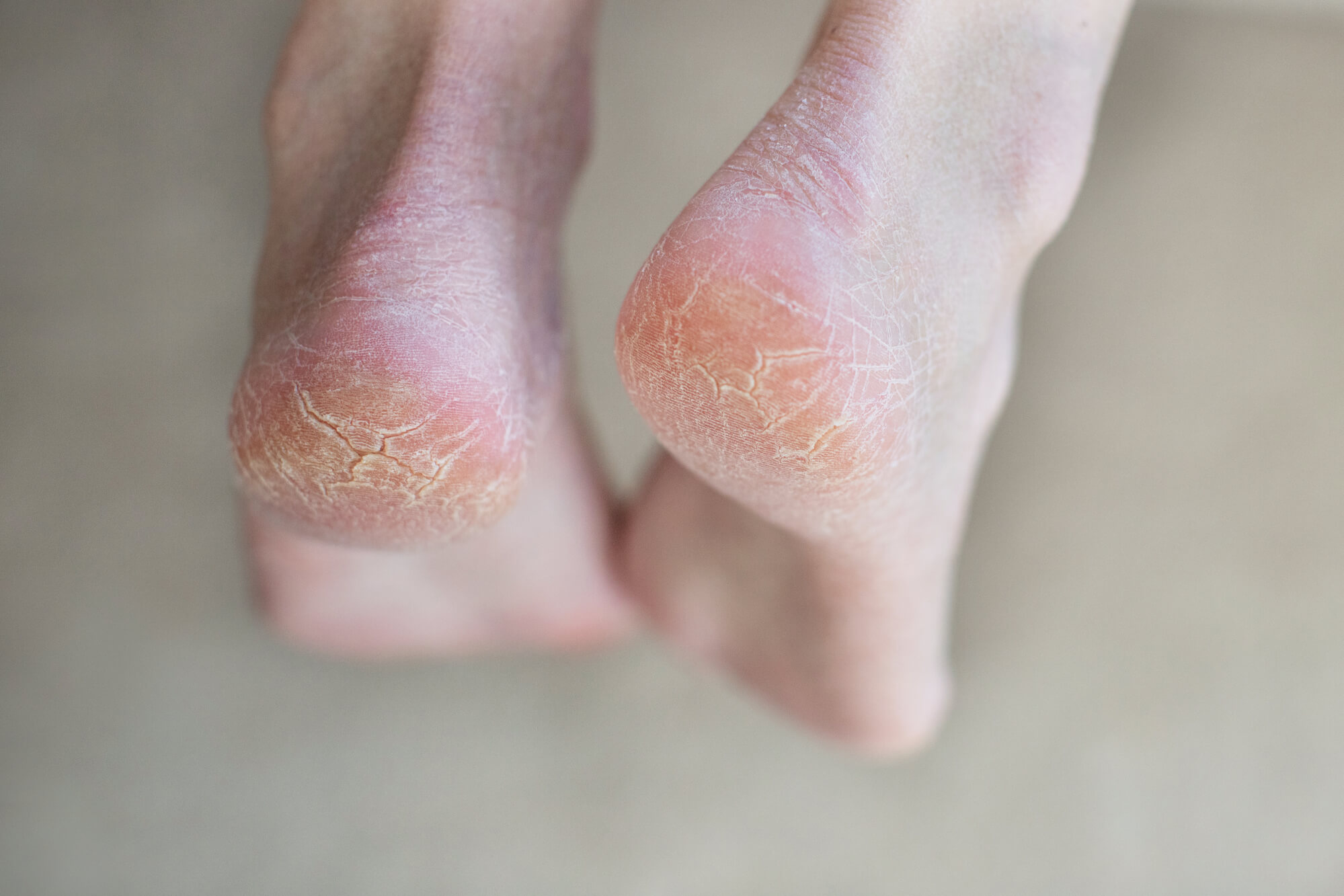 Why Are My Feet So Dry and Cracked? An Expert Guide to Foot Skin Health
