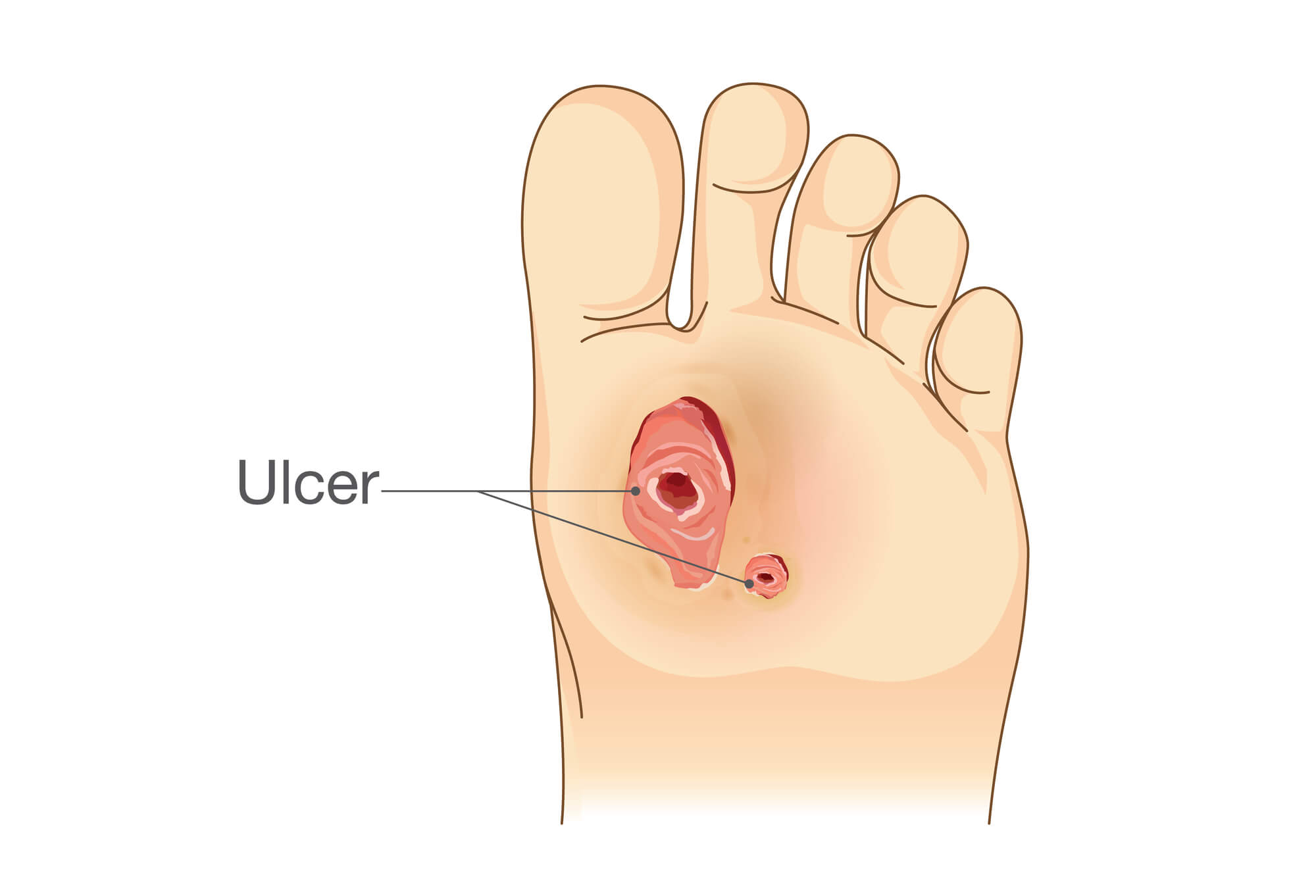 Pressure Injury 101: Stage 1 Pressure Ulcers