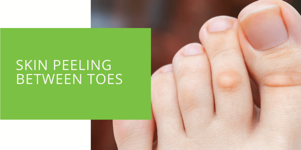 Toe peeling hot sale and itchy