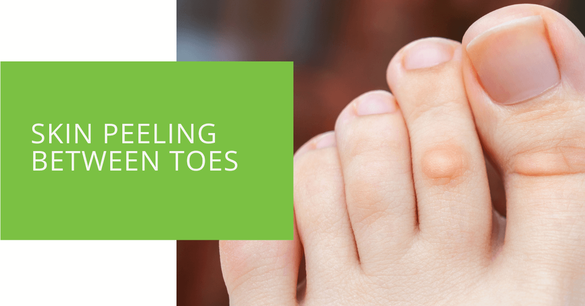 Cracked peeling skin sales between toes