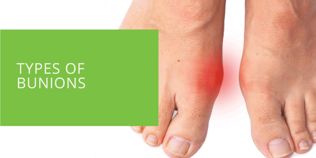 Types of Bunions